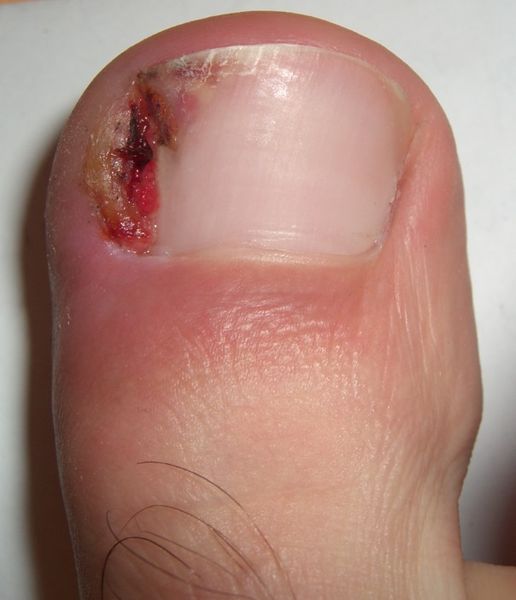 Ingrowing toe nail