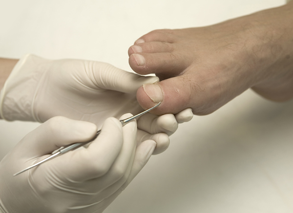 Thickened toe nails - Andrew Boyle Podiatry in Ainsdale, Formby