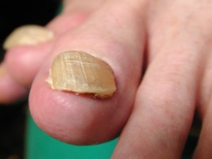 Thickened toe nail